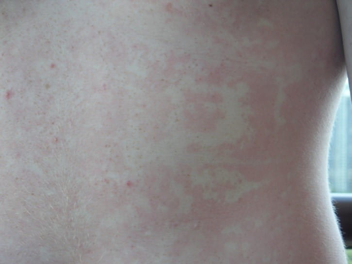 Erythema marginatum