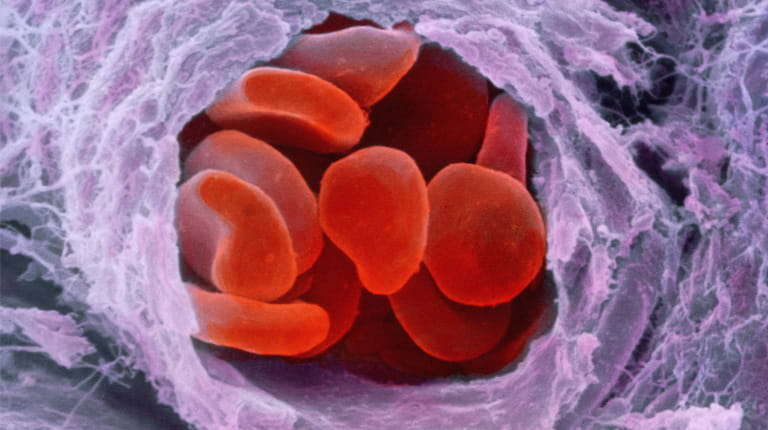 Genterapi til hæmofili